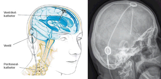 Hydrocephalus Shunt Market