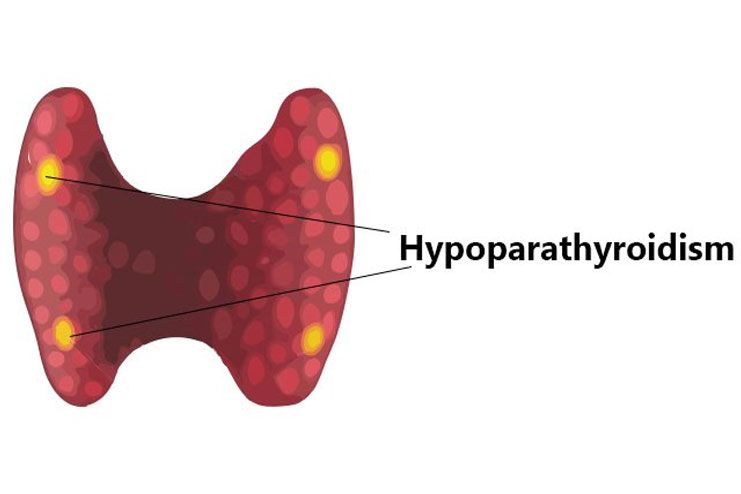 Hypoparathyroidism Treatment Market