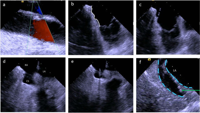 Intracardiac Imaging Market