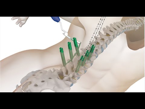 Pedicle Screw System Market