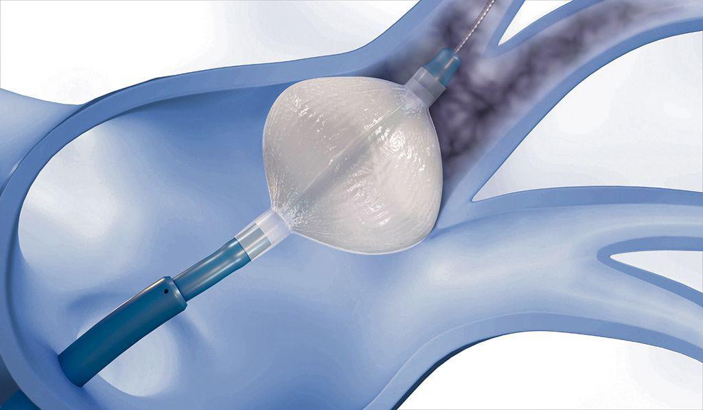 Radiofrequency Balloon Catheter Market