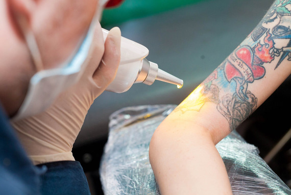 Tattoo Removal Laser Market