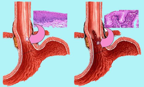 Barrett's Esophagus with Dysplasia Treatment Market