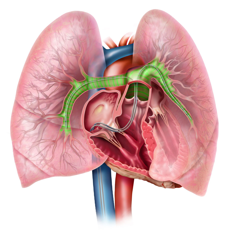 Catheter-Directed Thrombolysis Market