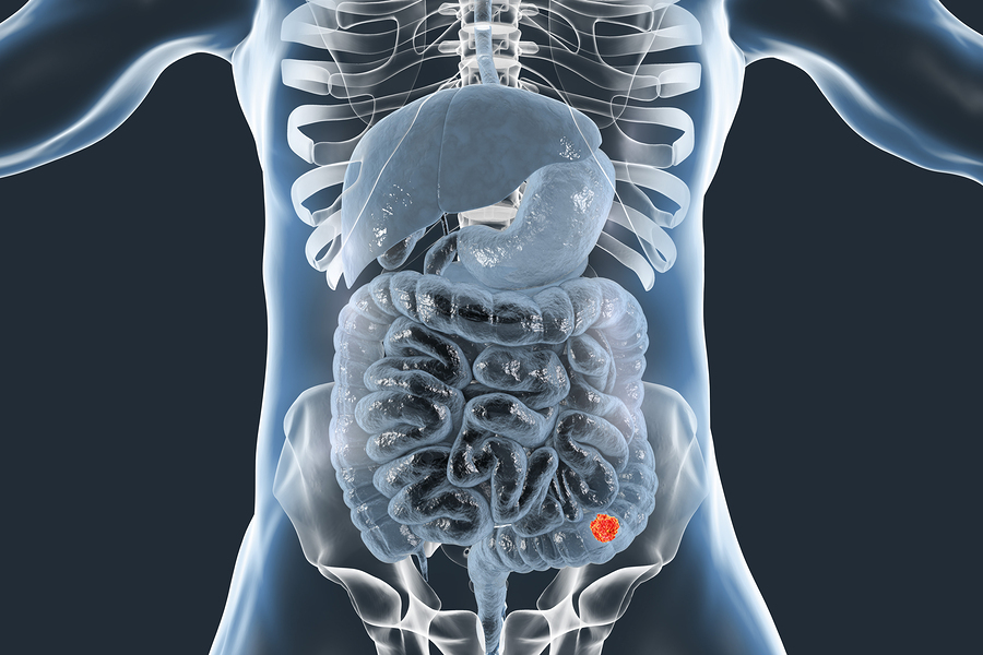 Gastroesophageal Junction Adenocarcinoma Therapeutics Market