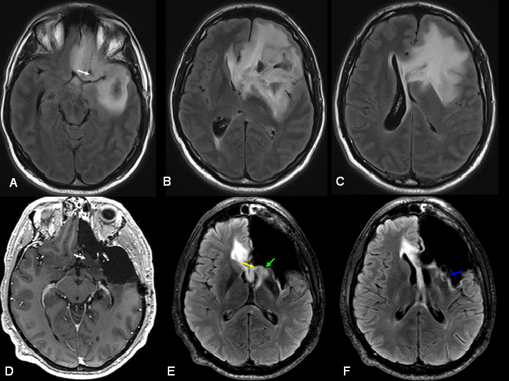 Low-Grade Glioma Therapeutics Market