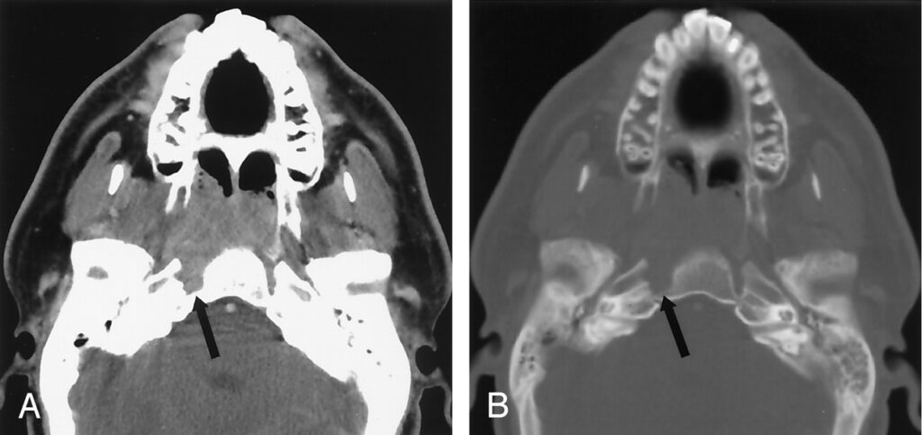 Nasopharyngeal Carcinoma Treatment Industry