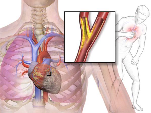 Stable Angina Management Market