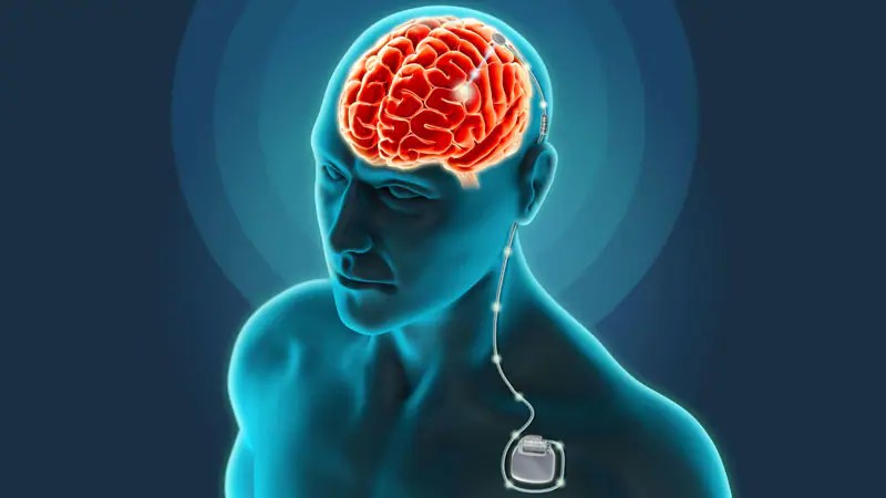 Deep Brain Stimulator Market