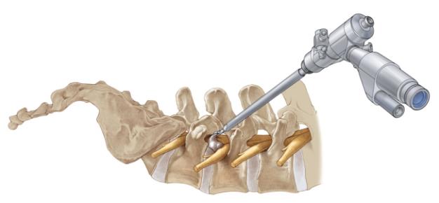 Spinal Devices Market