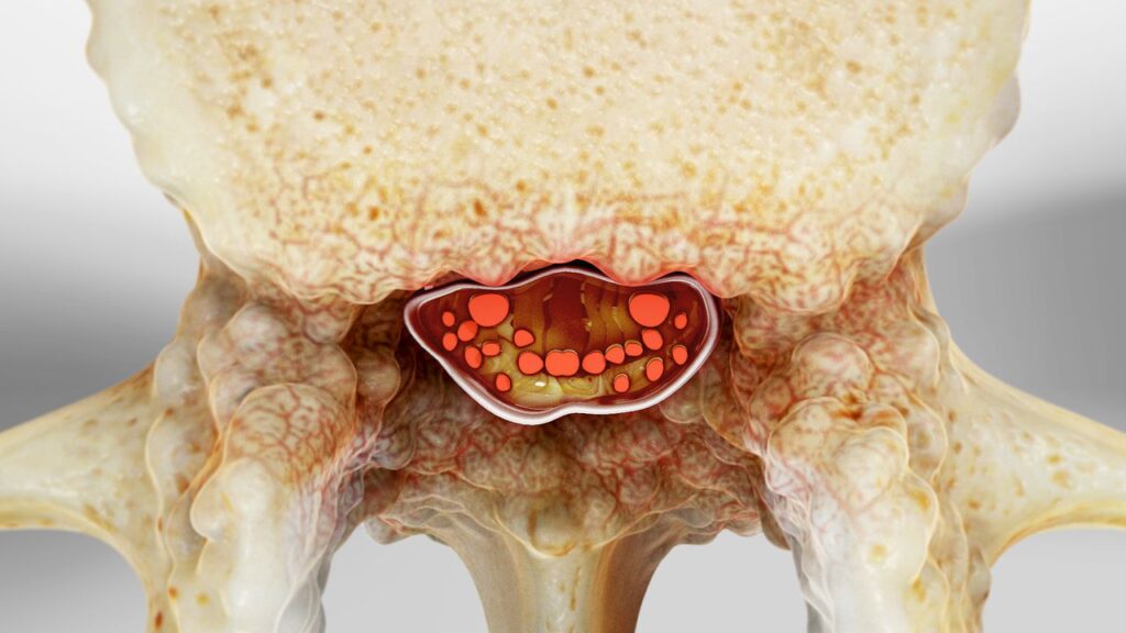 Spinal Stenosis Market