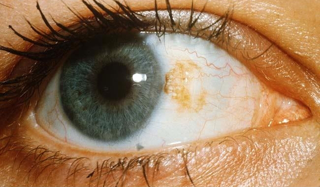 Uveal Melanoma Treatment Market